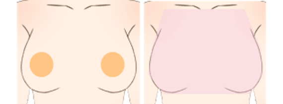 乳毛脱毛医療_figma