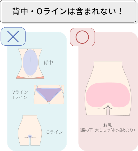 お尻脱毛_範囲_figma