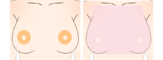乳毛脱毛美容_figma