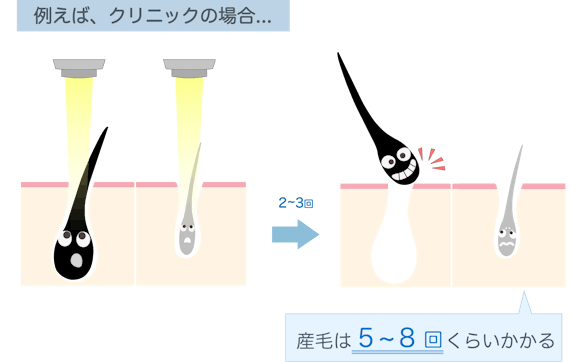 産毛_脱毛