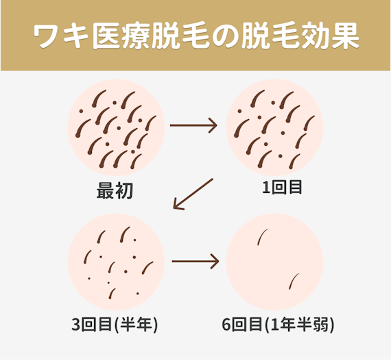 ワキ永久医療脱毛クリニックおすすめ4選 レーザー脱毛の効果回数 値段や痛みを解説 部位 脱毛 おすすめ脱毛 サロン クリニックの比較 口コミ情報メディア