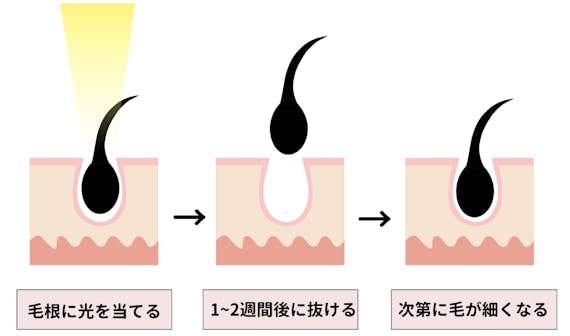 ライト脱毛_仕組み