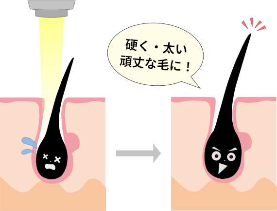 硬毛化