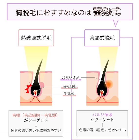 蓄熱式脱毛