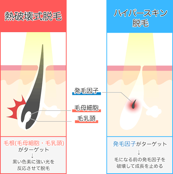 ハイパースキン脱毛