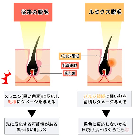 光脱毛方式_figma
