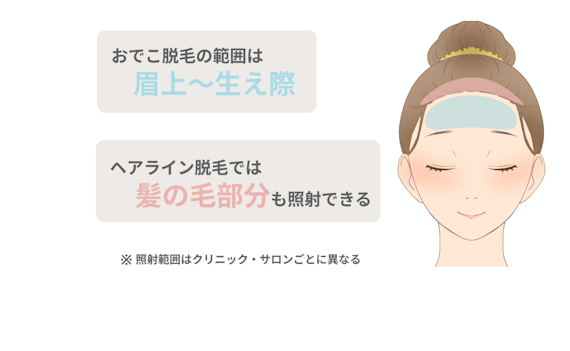 おでこ脱毛_範囲