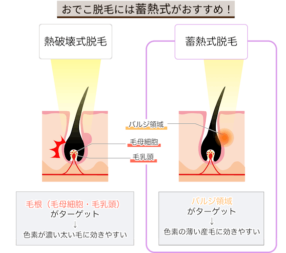 おでこ脱毛_脱毛方式_figma