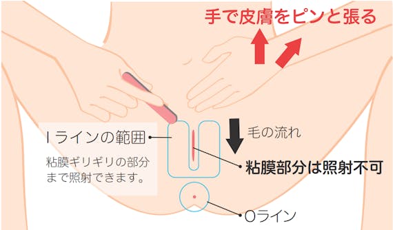 湘南美容外科_VIO範囲