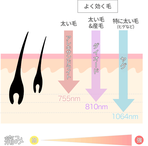 医療レーザー_種類