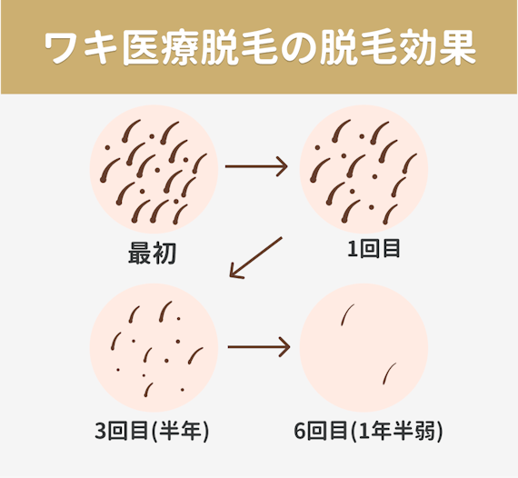 ワキ医療脱毛脱毛効果