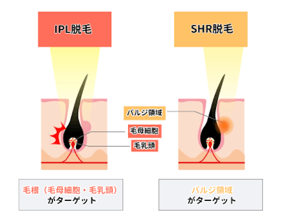 IPL脱毛とSHR脱毛の違い_figma