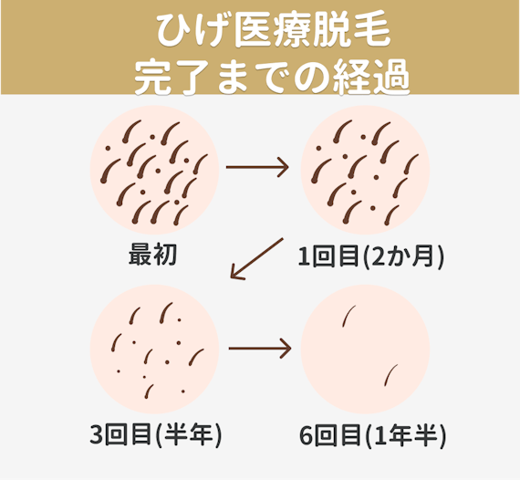 女性のひげの処理 脱毛どうする 自己処理の方法や回数 値段まで徹底解説 部位 脱毛 おすすめ脱毛サロン クリニックの比較 口コミ情報メディア